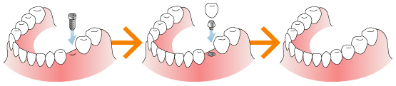 インプラントとブリッジと入れ歯の比較　インプラント
